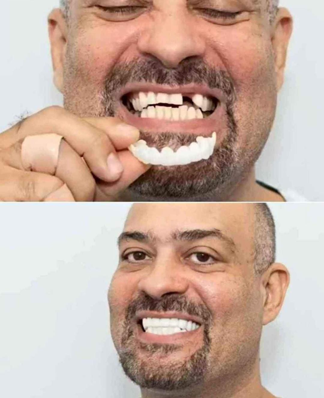 Carillas Dentales Snap-On Smile - Set x2